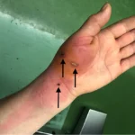 Warning: Cat Bite Infection Symptoms You Can’t Afford to Miss