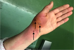 Read more about the article Warning: Cat Bite Infection Symptoms You Can’t Afford to Miss